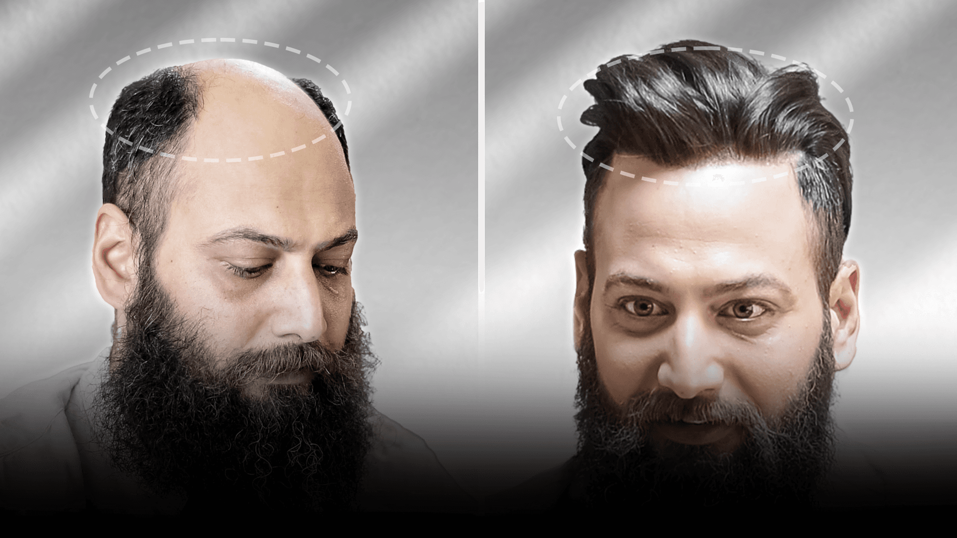 Before and after stick-on hair system result for Chandan Singh.