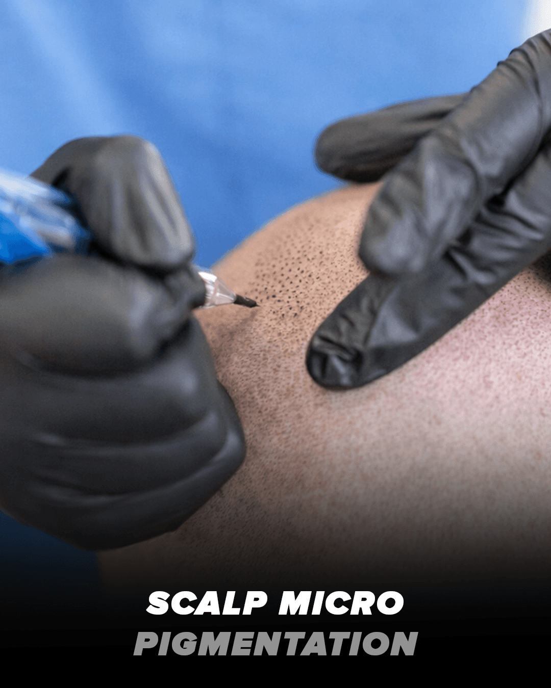 Scalp Micro Pigmentation procedure result — natural-looking hairline