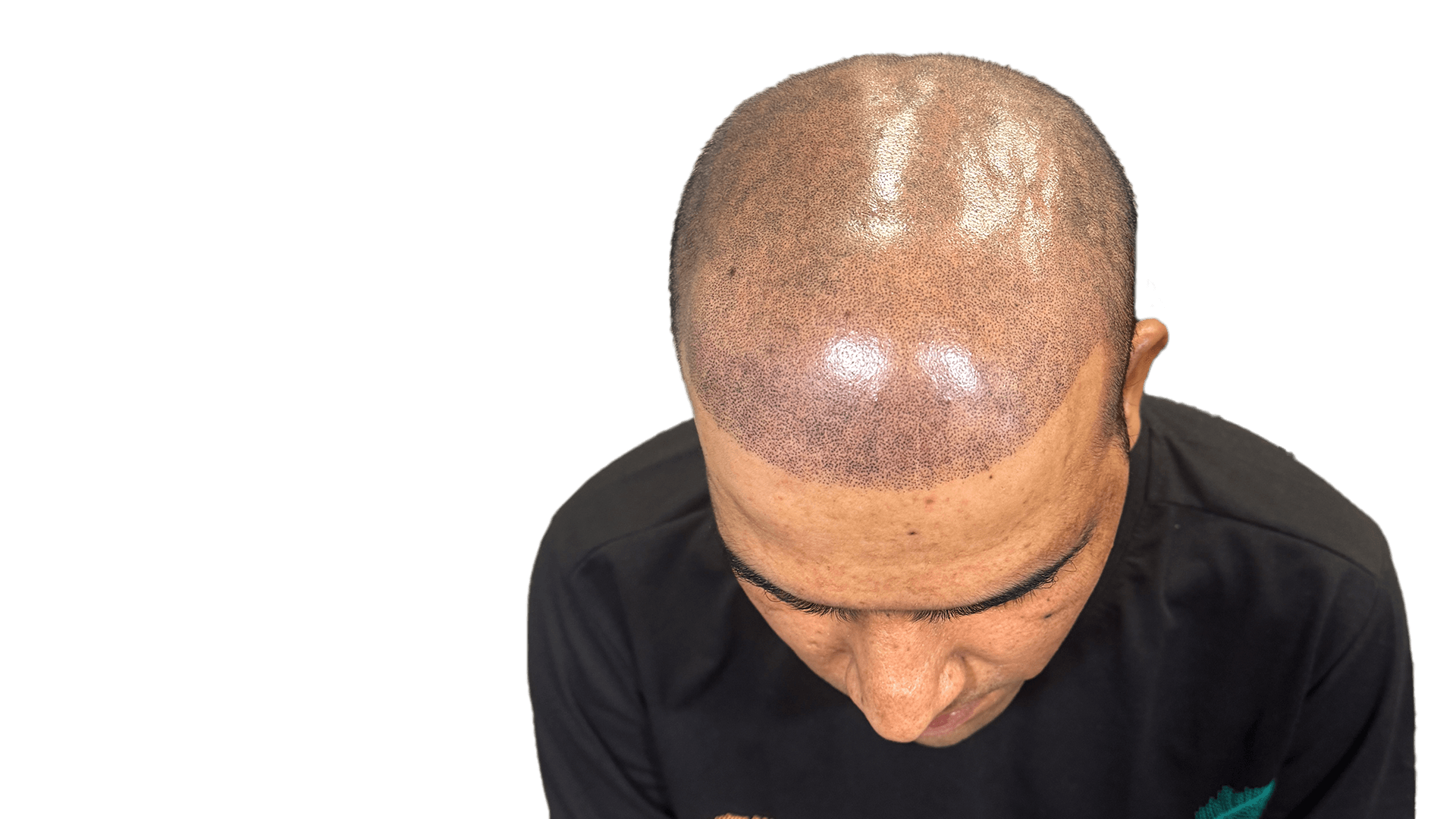 About Scalp Micropigmentation — SMP procedure card image