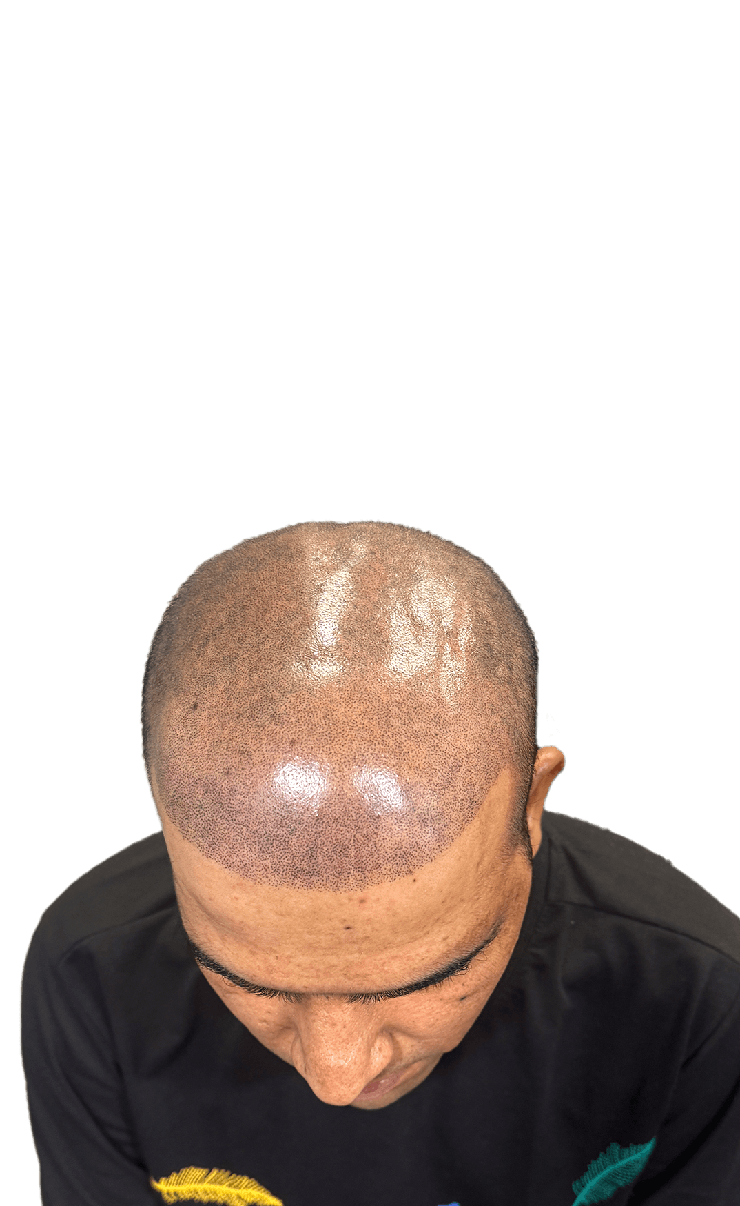About Scalp Micropigmentation — SMP procedure card image