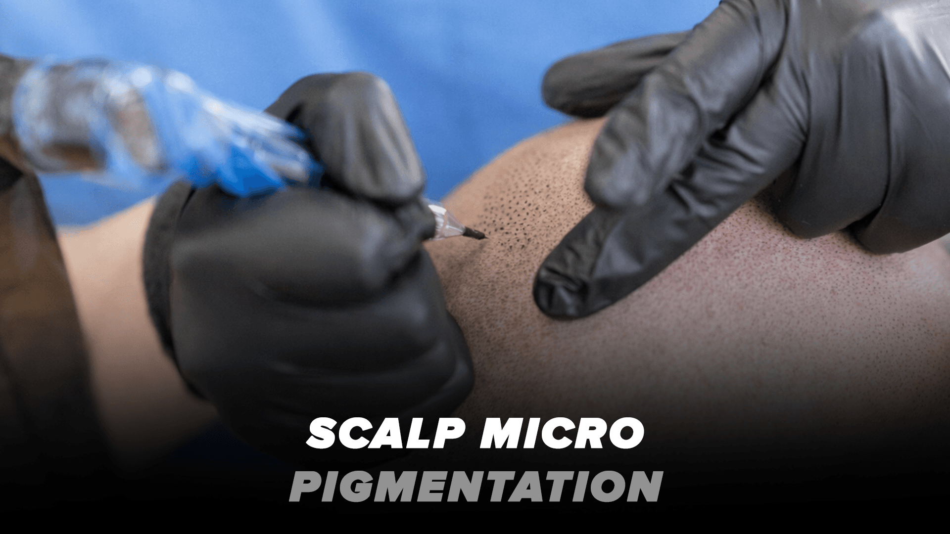Scalp Micro Pigmentation procedure result — natural-looking hairline