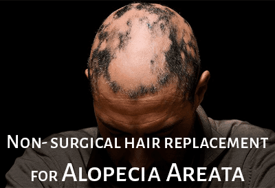 Hair Replacement for Alopecia Areata