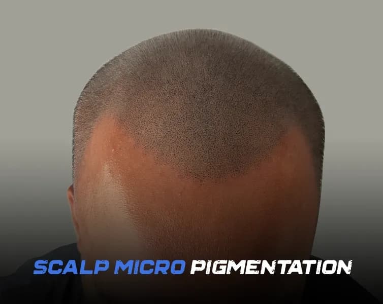 Scalp Micropigmentation Aftercare –  SMP Do’s and Don’ts