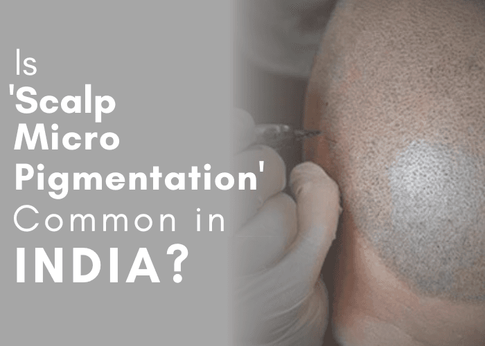 Is Scalp Micro Pigmentation Common in India ?