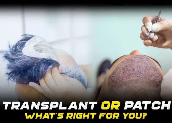 Hair Patch For Men or Hair Transplant in India: What’s Right for You?