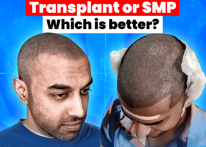 Scalp Micropigmentation vs. Hair Transplant: Which is the Better Option?