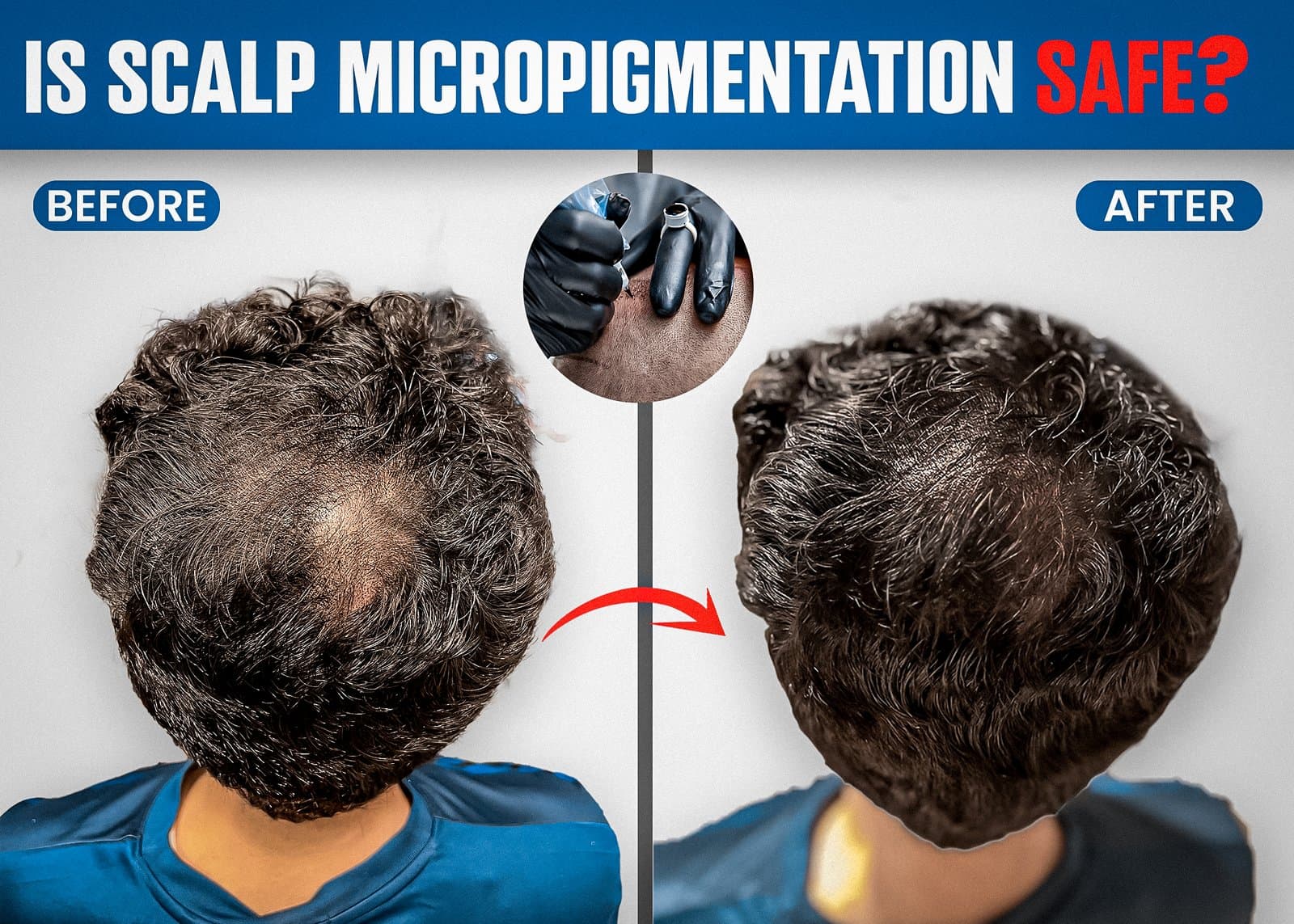 Top Reasons Why Scalp Micropigmentation is the Best Choice for Thinning Hair