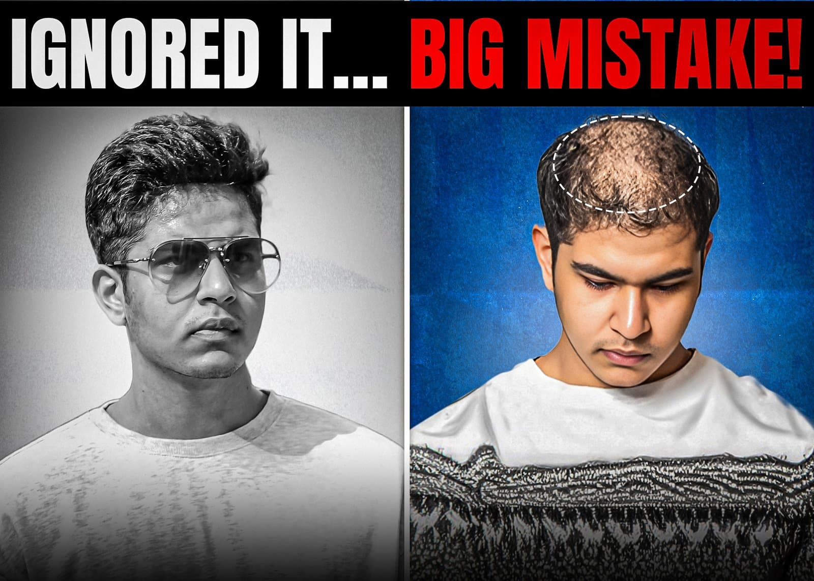Why 80% of Young Men Regret Ignoring Early Hair Loss
