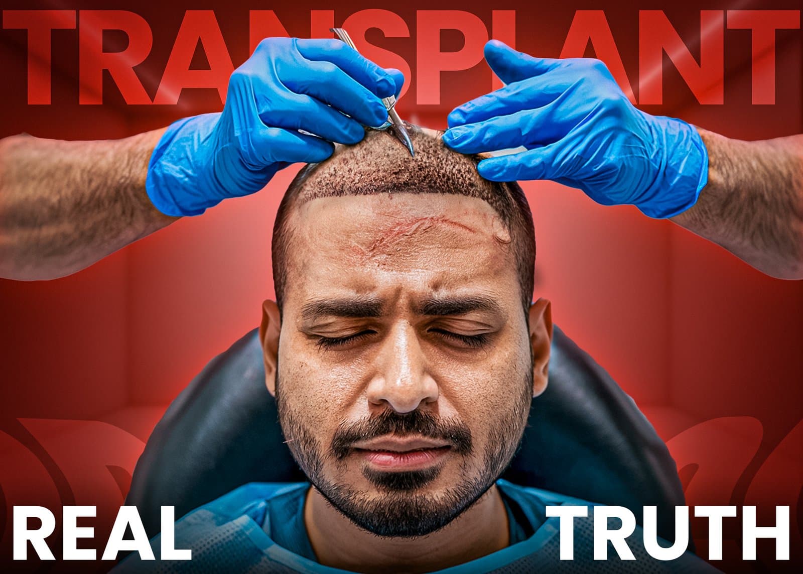 Hair Transplants Are a Trap? What No One Tells Indian Men About Regrowth