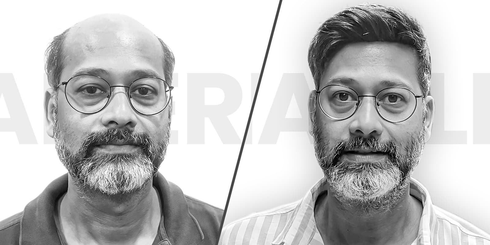 Hair Transplants vs. Hair Patches: What’s Best for Wedding Season?