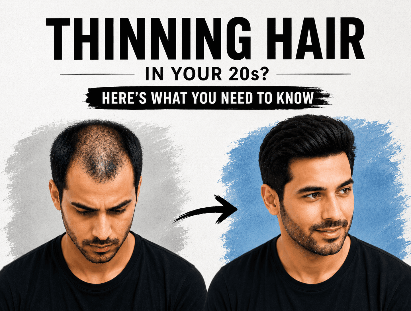 The Truth About Thinning Hair in Your 20s: What You Need to Know