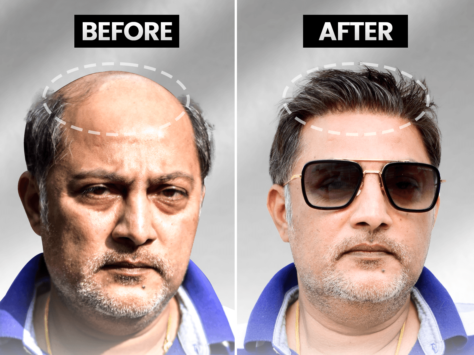 Before and after stick-on hair system transformation showing an ultra-signature natural hairline.