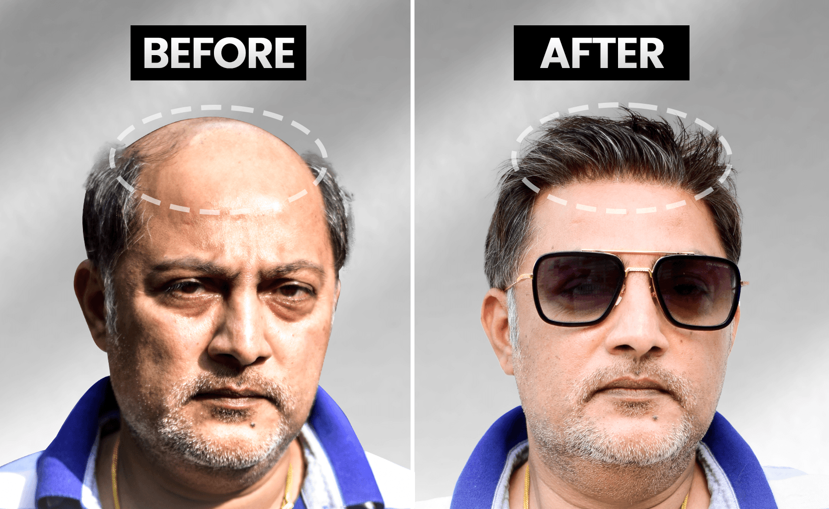 Mobile before and after stick-on hair system transformation showing an ultra-signature natural hairline.