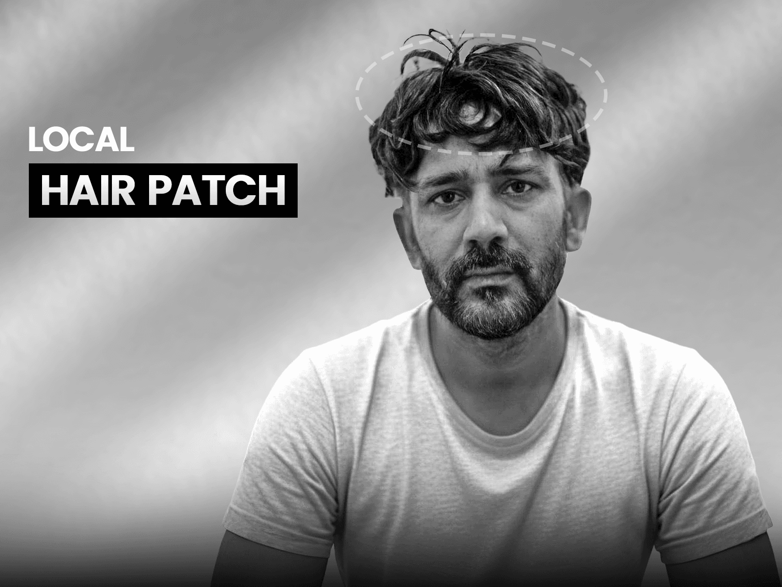 Local hair patch example showing an unnatural hairline and poor blend.