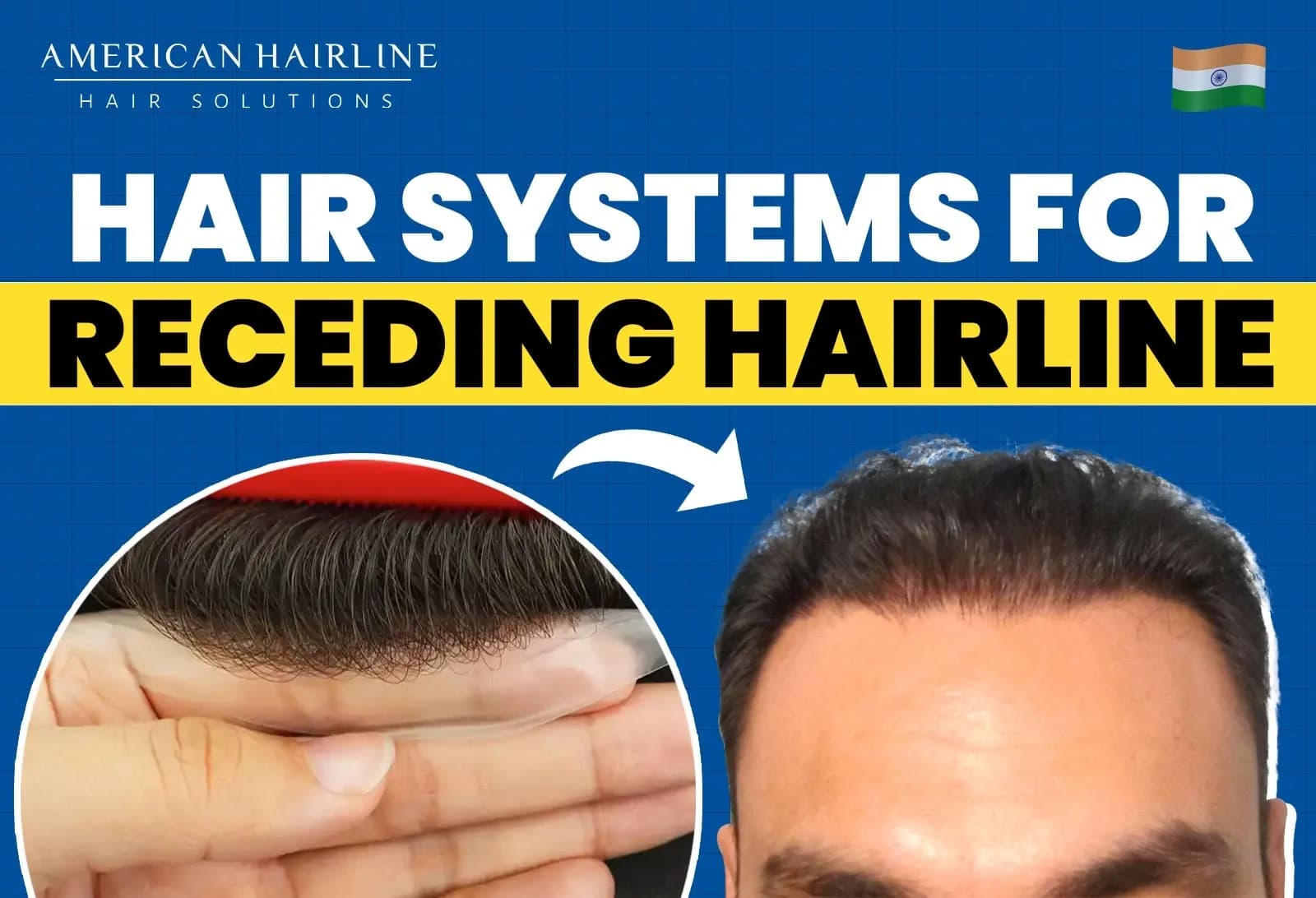 How to Fix a Receding Hairline with Hair Systems?