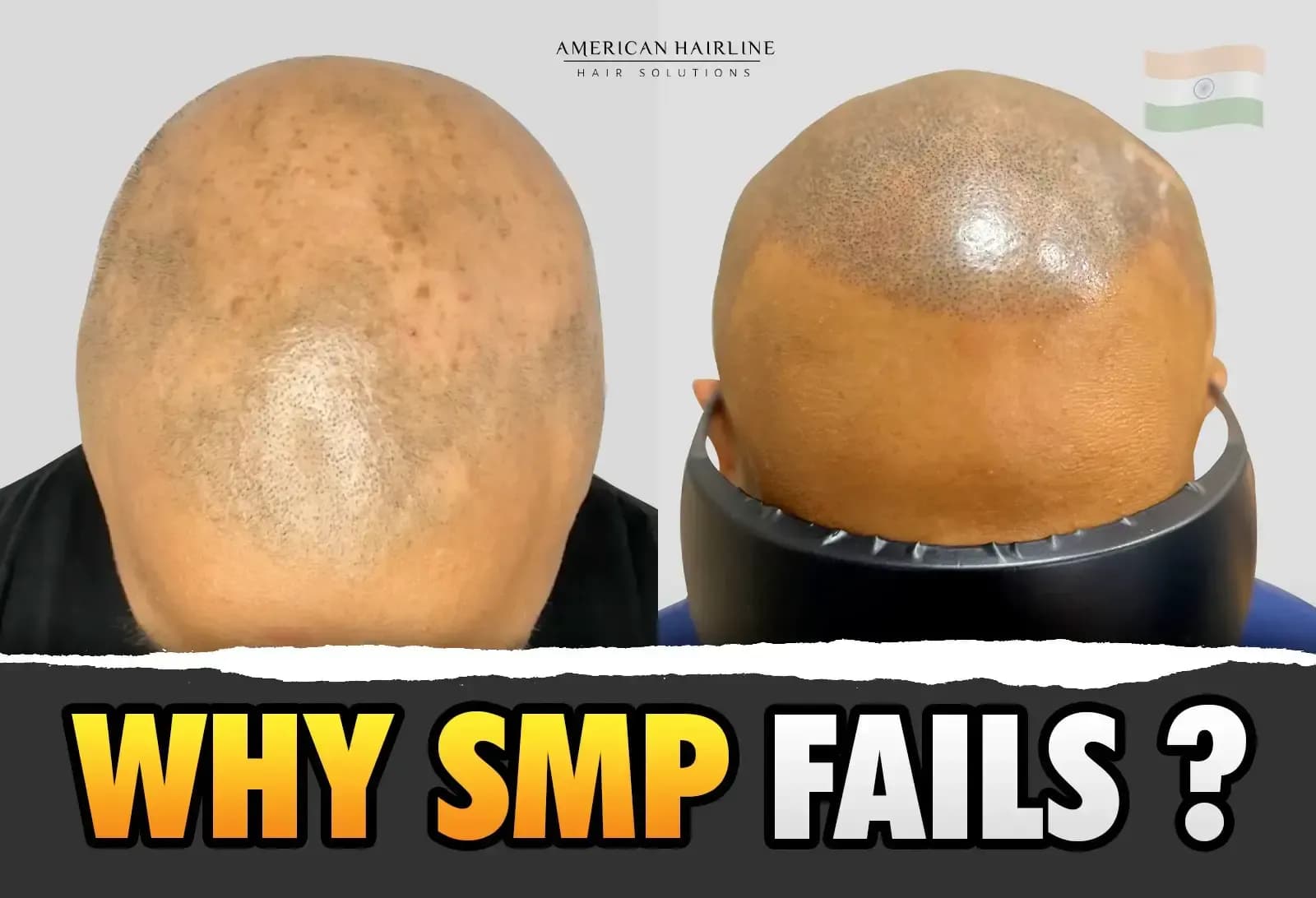 Why Scalp Micropigmentation Goes Wrong?