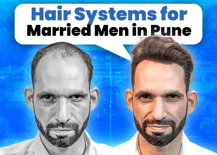 Hair Systems for Married Men in Pune