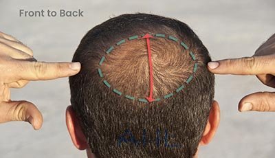 crown area hair patch measurement