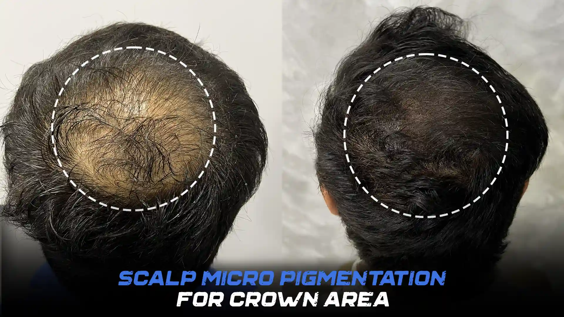 Scalp Micro Pigmentation for crown area