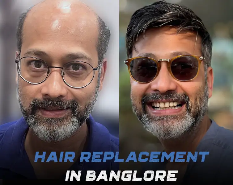 Non Surgical Hair Replacement In Bangalore Hair Patch Wigs For Men