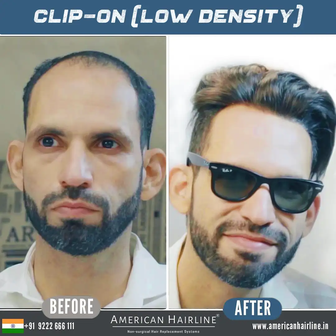 clip on low density 1