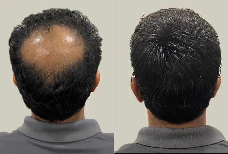 crown area hair systems for men