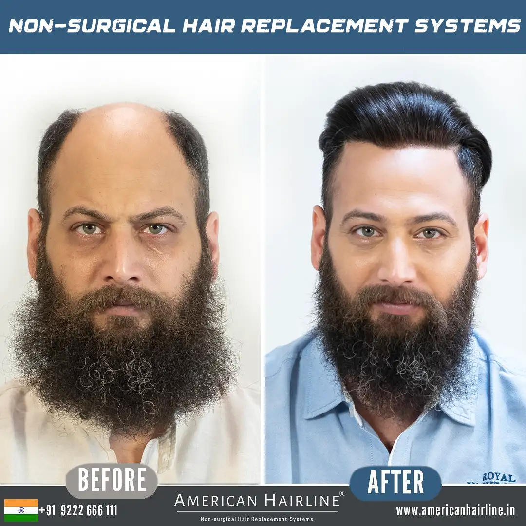 natural hair replacement systems for men
