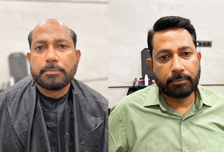 Hair wigs for men in Kolkata