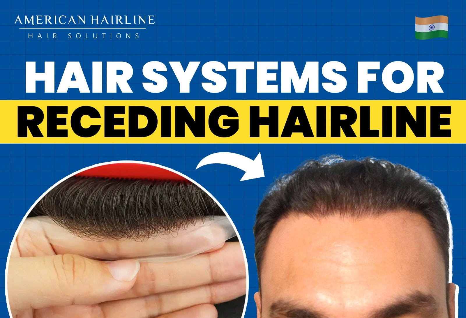 How to Fix a Receding Hairline with Hair Systems
