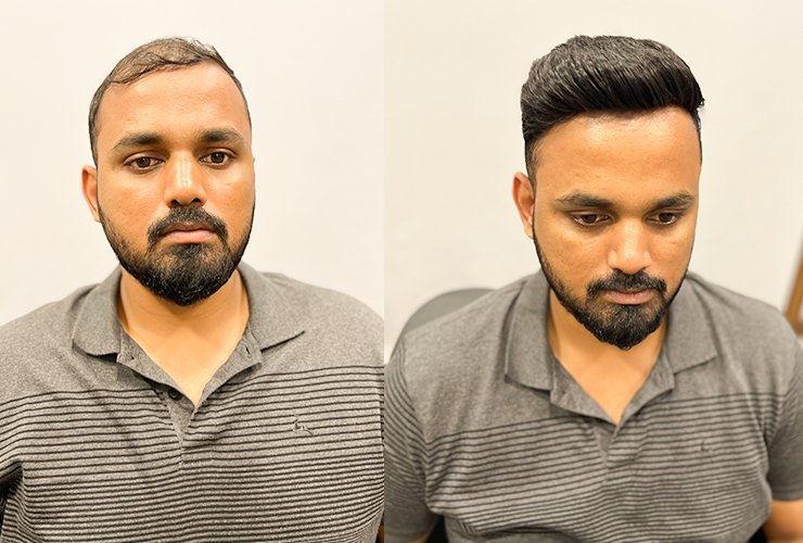 hair wig for men (Before and after image of one men his wearing the wig)