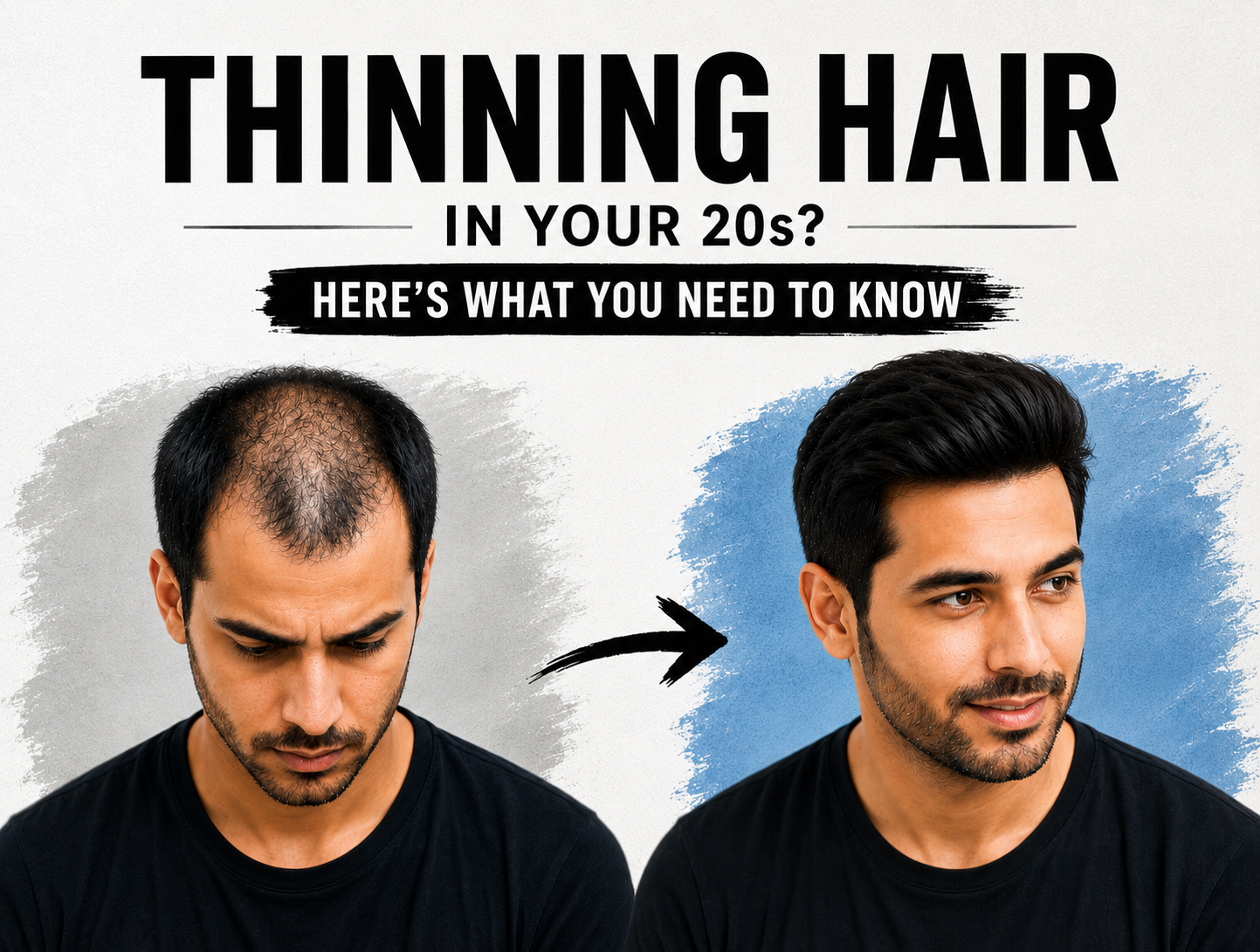Young man in his 20s checking his thinning hairline in a mirror, highlighting early signs of hair loss and modern non-surgical hair replacement solutions.