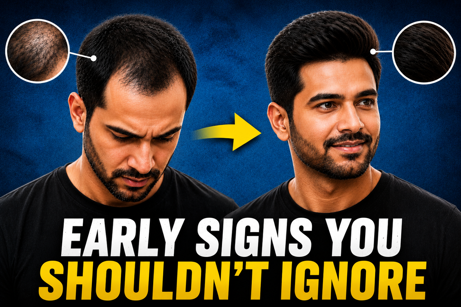 Early signs of male pattern baldness shown through a before-and-after transformation. The left side features a man with a receding hairline and thinning crown, while the right side shows the same man with a full, natural-looking hairstyle after non surgical hair replacement. Close-up circles highlight hair density differences, with the text "Early Signs You Shouldn't Ignore."